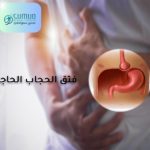 فتق الحجاب الحاجز